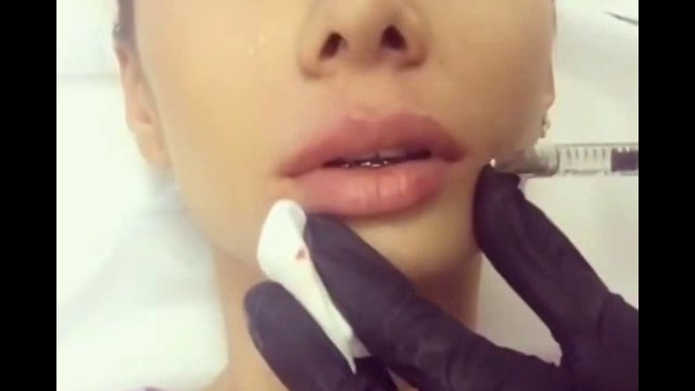 Инжектиране на хиалуронова киселина в устните