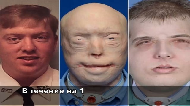 Най-шокиращите трансплантации на лице
